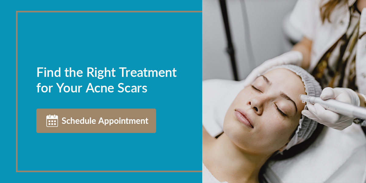 Find the Right Treatment for Your Acne Scars