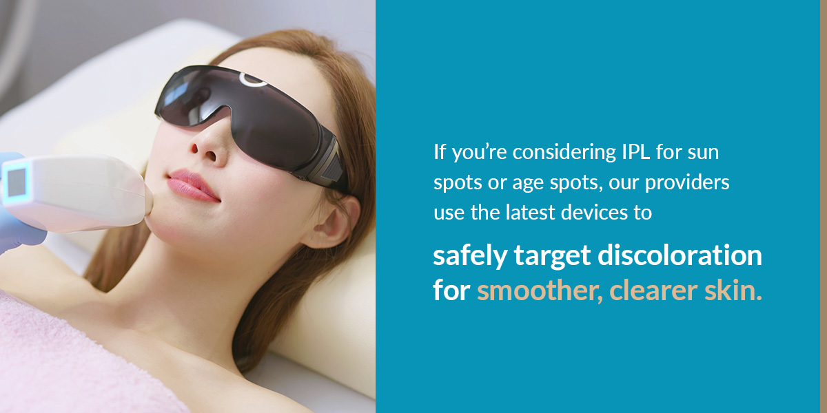 considering IPL for sun spots or age spots