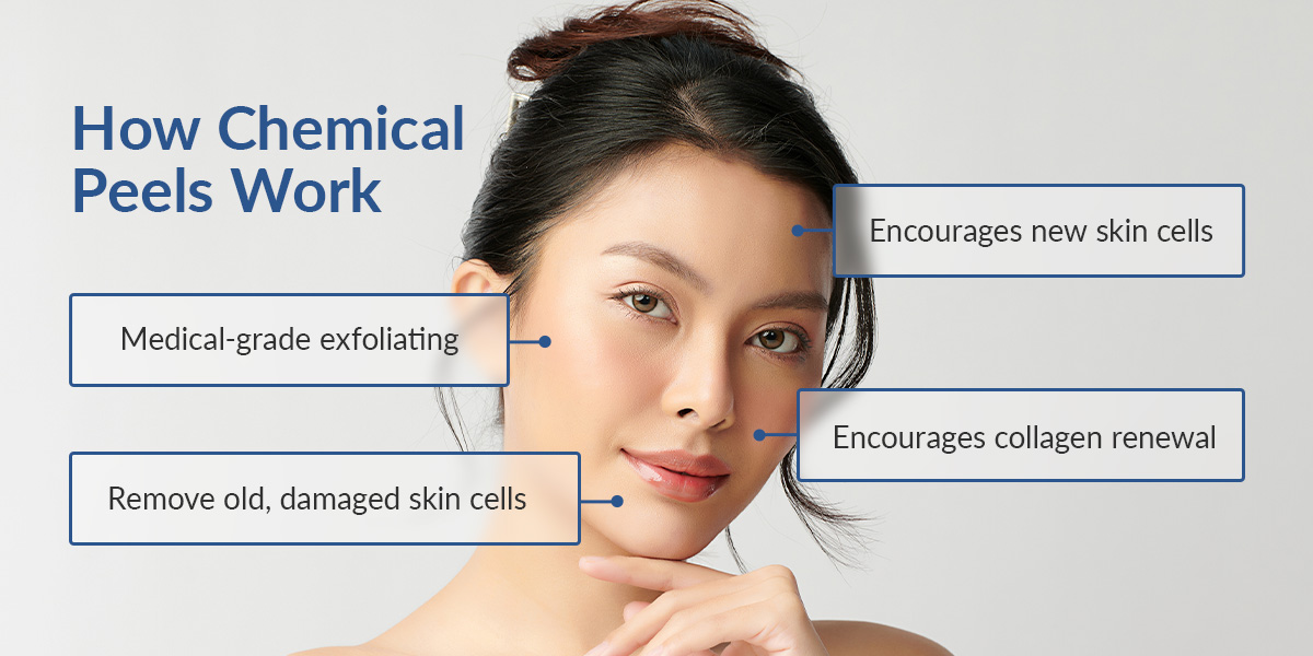How Chemical Peels Work
