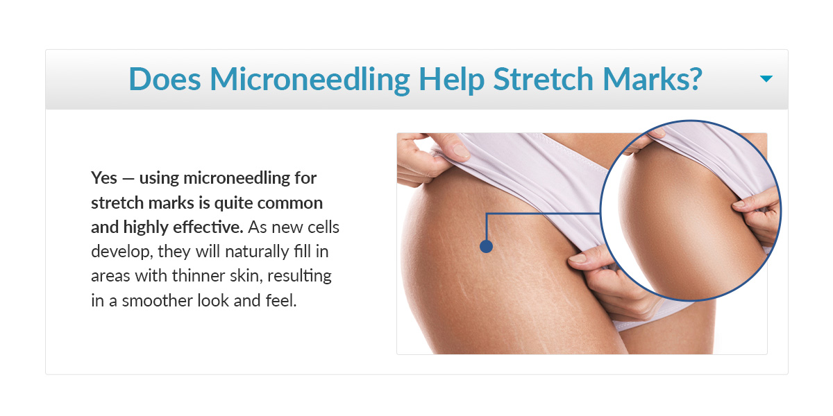 Does Microneedling Help Stretch Marks?