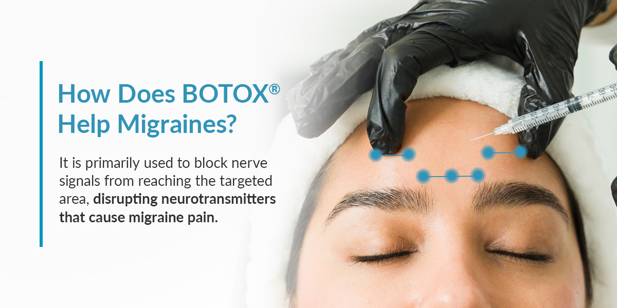 How Does BOTOX® Help Migraines?