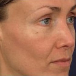 After treatment: Broken Capillaries & Redness