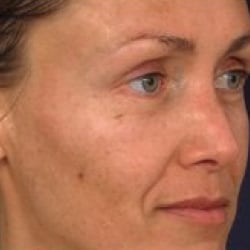 Before treatment: Broken Capillaries & Redness