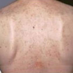 After treatment: Brown Spots