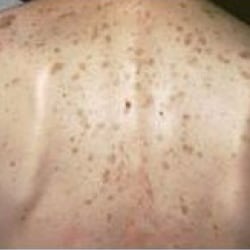 Before treatment: Brown Spots