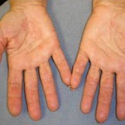 After treatment: Psoriasis
