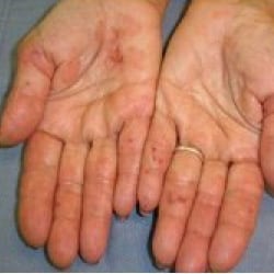 Before treatment: Psoriasis