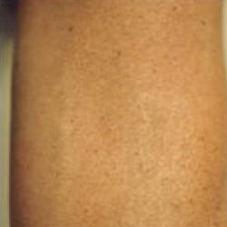After treatment: Tattoo Removal