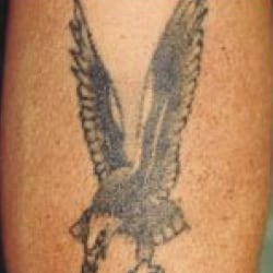 Before treatment: Tattoo Removal