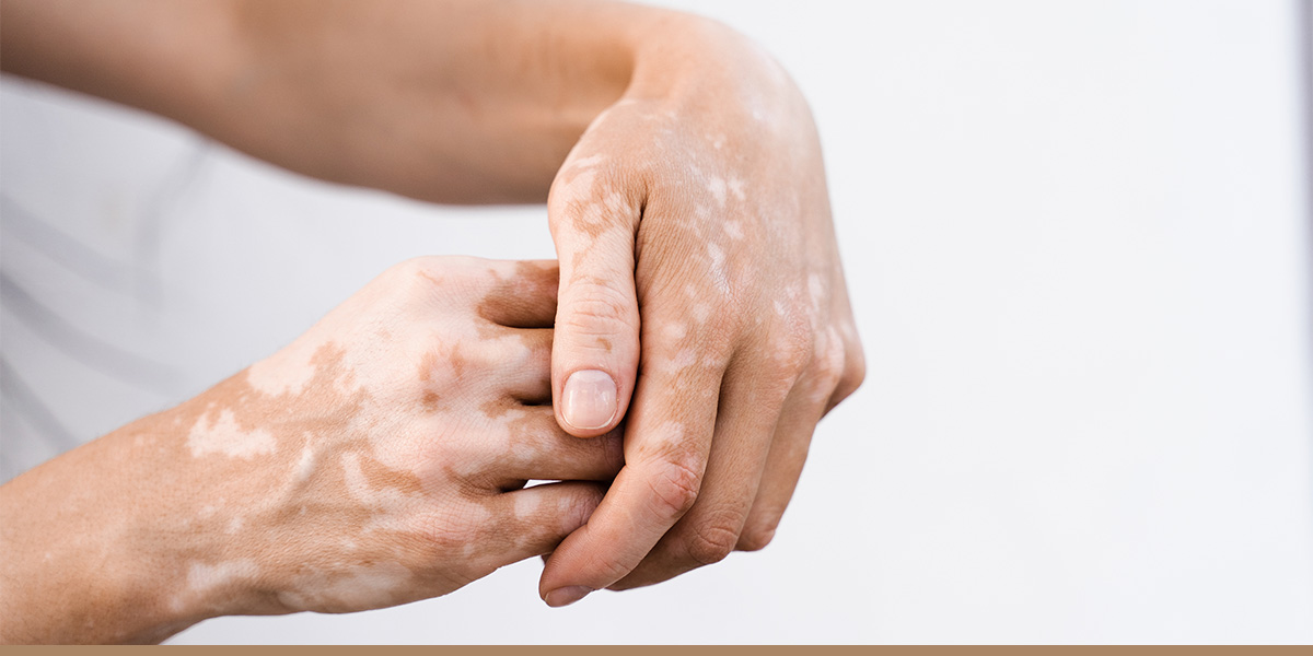 Losing Color Vitiligo Signs, Diagnosis & Latest Treatment Options