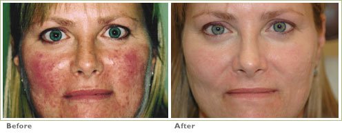 photodynamic therapy acne