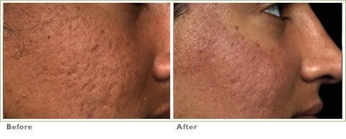 fraxel acne scars