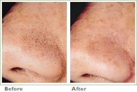 Microdermabrasion