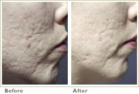 Microdermabrasion for Acne Scars