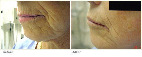 wrinkles aging10
