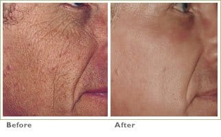 Laser Skin Resurfacing