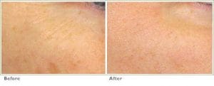 Fraxel™ Laser Treatment