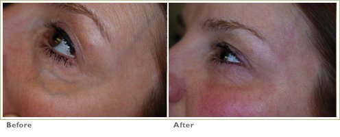 CoolGlide Laser for Blue Veins around the Eyes/Face