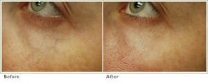 CoolGlide Laser for Blue Veins around the Eyes/Face
