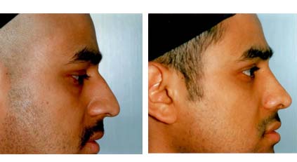 Nose Job / Nasal Surgery
