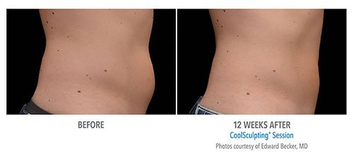 CoolSculpting for Stomach, Belly Fat & Abs , CoolSculpting vs Liposuction