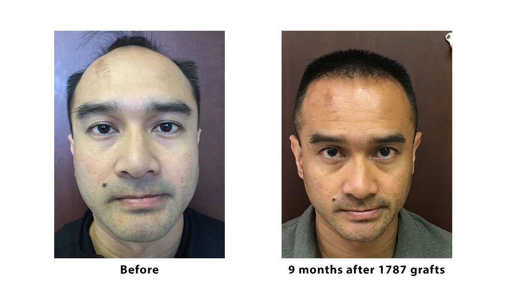 artas hair transplant near me