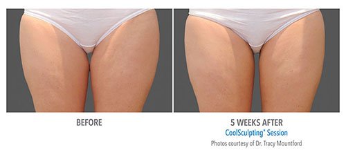 Los Angeles Liposuction Centers on X: Female patient is one year post op  from Smartlipo of her upper back and bra fat. Her results? A leaner,  curvier and more defined back. Who