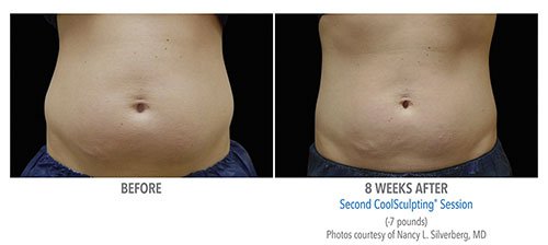 CoolSculpting Treatment for Love Handles—Reduce Unwanted Waist Fat