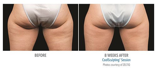 CoolSculpting treatment on butt and thighs - before and after photo