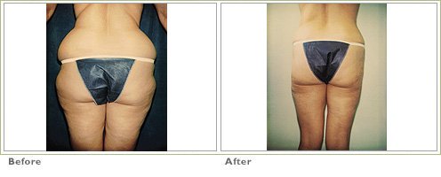 Los Angeles Liposuction Centers on X: Female patient is one year post op  from Smartlipo of her upper back and bra fat. Her results? A leaner,  curvier and more defined back. Who