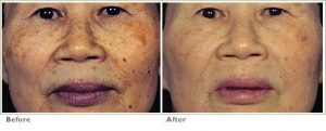 Fraxel™ Laser Treatment for Brown Spots