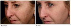 Fraxel™ Laser Treatment for Brown Spots