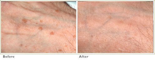 Fraxel™ Laser Treatment for Brown Spots