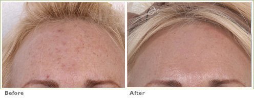 Fraxel™ Laser Treatment for Brown Spots