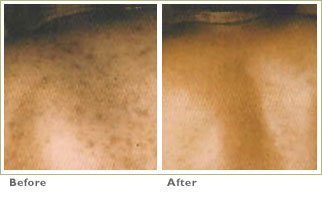 Microdermabrasion for Brown Spots