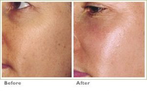 Laser Skin Resurfacing for Brown Spots