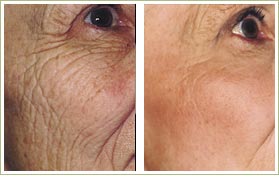 Laser Skin Resurfacing for Brown Spots