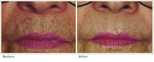Laser Skin Resurfacing for Brown Spots
