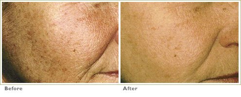 Chemical Peels for Brown Spots