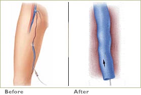 endovenous4