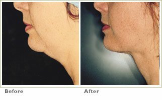 double chin laser - laser lipo double chin before and after