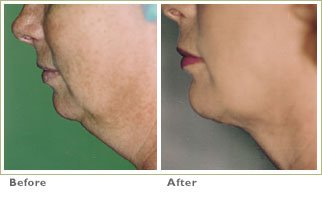 laser double chin removal