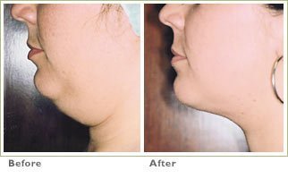 laser lipo face