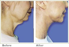 laser lipo before and after chin