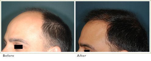 Strip Harvest Hair Transplantation (FUT technique)