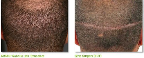 Strip Harvest Hair Transplantation (FUT technique)