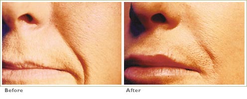 Restylane & Perlane for Lip Enhancement