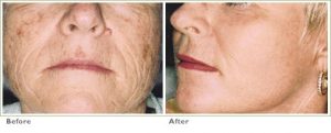 Laser Skin Resurfacing for Precancers/Actinic Keratoses