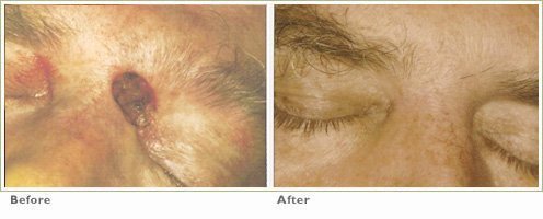 Photodynamic Therapy for Precancers/Actinic Keratoses