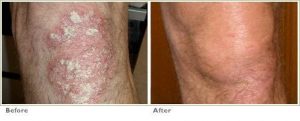 psoriasis2